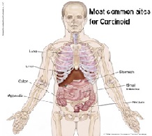 Carcinoid Cancer